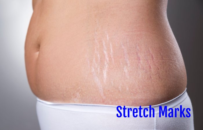 Stretch Marks