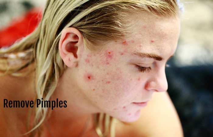 face pimples