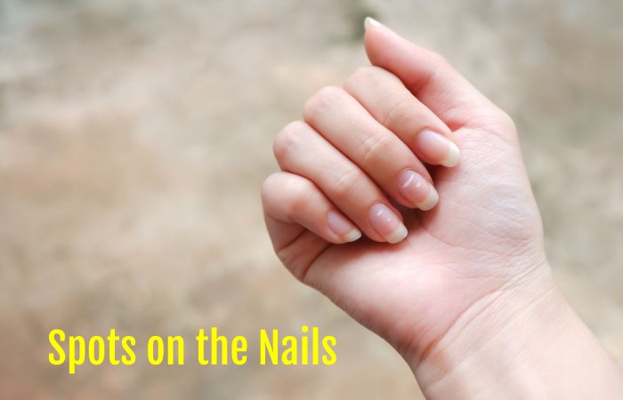 spots on nails