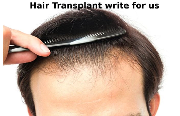 Hair Transplant write for us