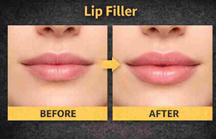 lip filler