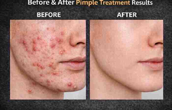 pimple treatment results