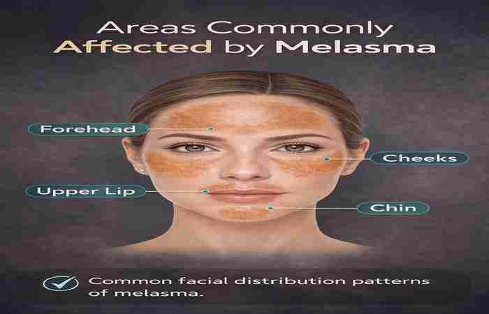 areas commonly affected by melasma