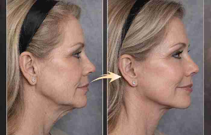 vertical facelift result